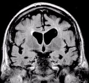 Brain scan